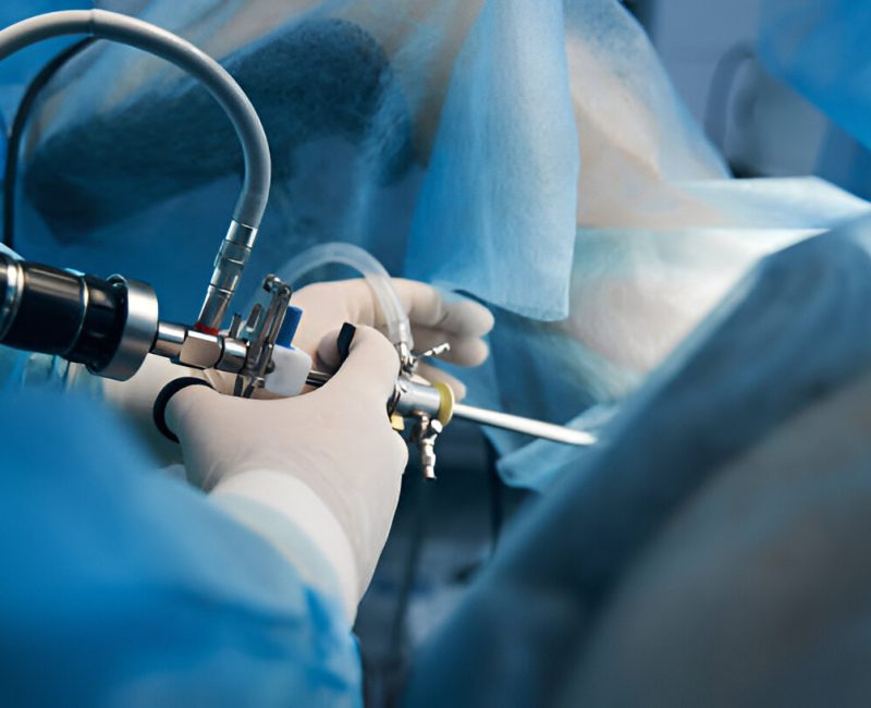 Laparoscopy